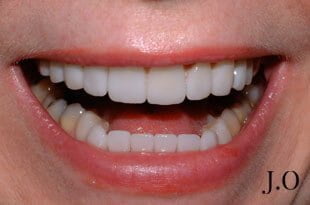 chipped and worn smiles 012 after