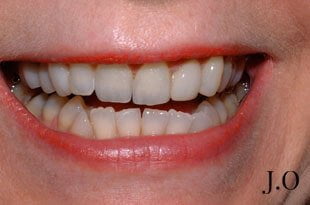 chipped and worn smiles 012 before