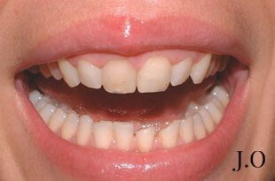 chipped and worn smiles 014 before