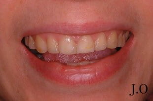 chipped and worn smiles 016 before