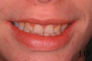 chipped and worn smiles 017 before