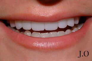 chipped and worn smiles 02 after