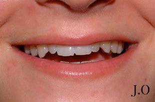 chipped and worn smiles 02 before