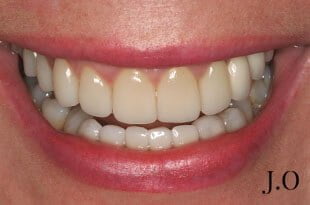 chipped and worn smiles 020 after