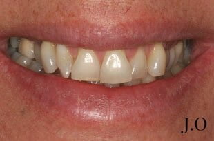 chipped and worn smiles 023 before