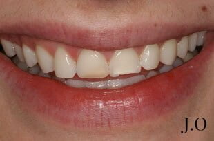 chipped and worn smiles 027 before