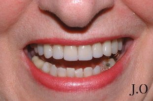 chipped and worn smiles 03 after