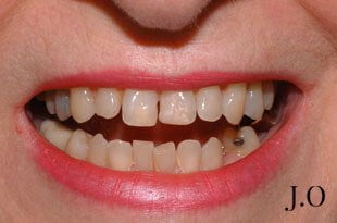 chipped and worn smiles 03 before