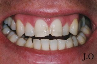 chipped and worn smiles 07 before