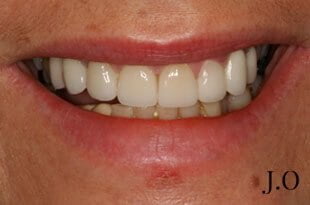 chipped and worn smiles 08 after