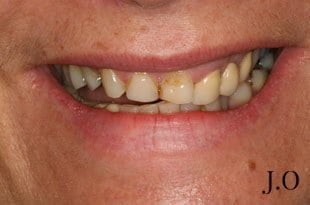 chipped and worn smiles 08 before