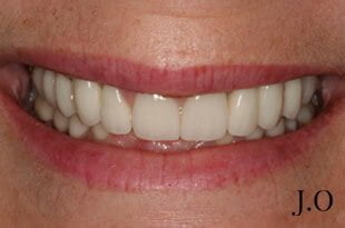 chipped and worn smiles 09 after