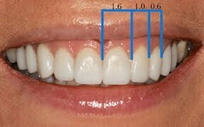 Correct tooth proportions