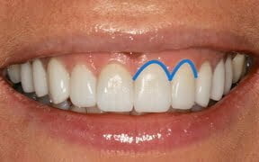 Crescent Shaped Gums