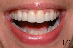 Crowded Teeth After Veneers