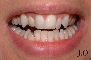 crowded teeth 01 before veneers