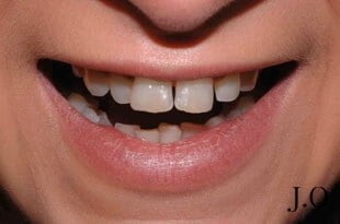 Crowded Teeth Before Porcelain Veneers