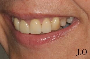 crowded teeth 027 after