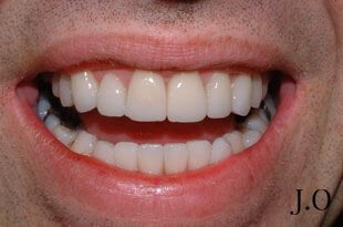 crowded teeth 04 after