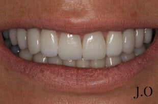 crowded teeth 046 after