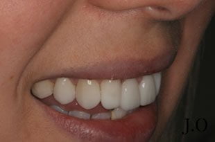 crowded teeth 09 after