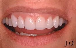 After Gum Reshaping 