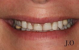 smile makeover 08 before