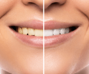 Teeth Whitening Manchester